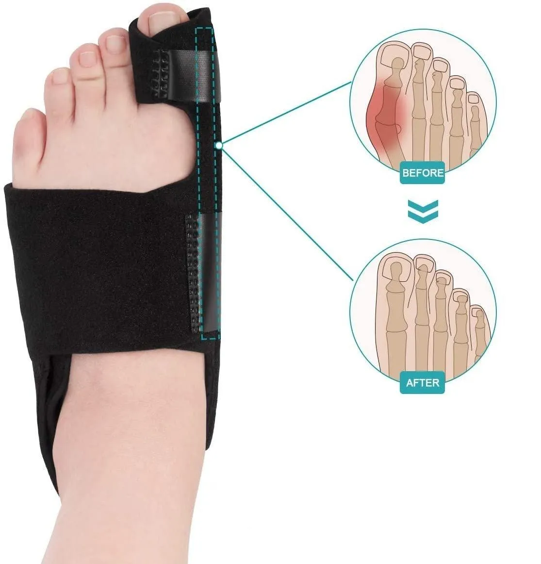 Bunion Splint for Severe Bunion